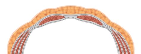 abdomac|Lehrbeitrag zum Wechsel eines Abdominellen  .